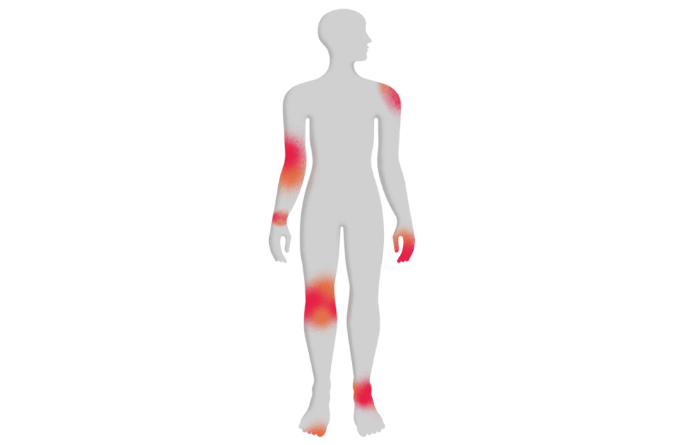 Most common areas of the body for PsA symptoms
