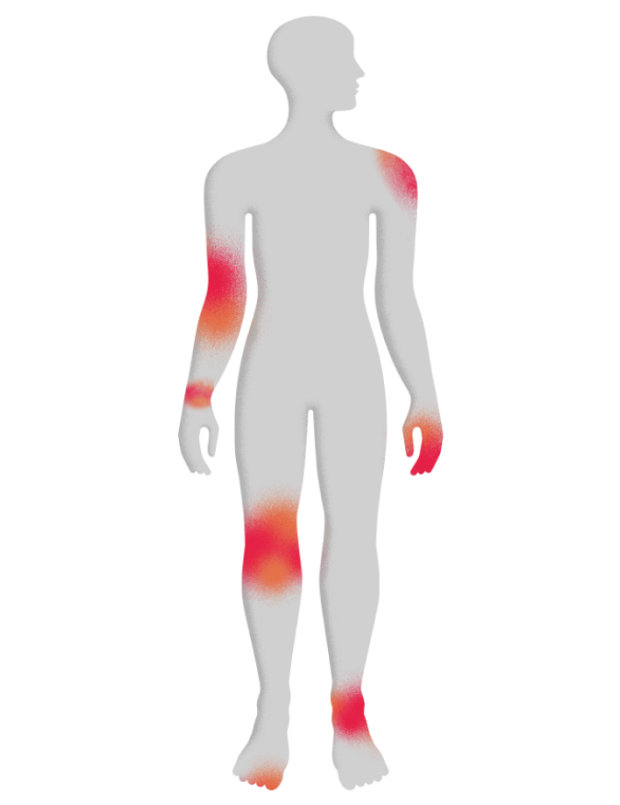 Most common areas of the body for PsA symptoms