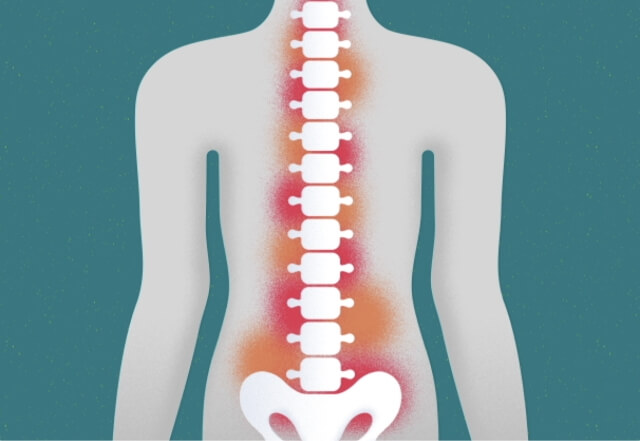 What is AS inflammation