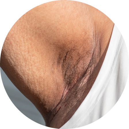 Image of moderate HS rash